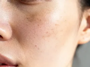 Szklana buteleczka z serum z kwasem salicylowym na marmurowym blacie w otoczeniu roślin, podkreślająca świeżość pielęgnacji.